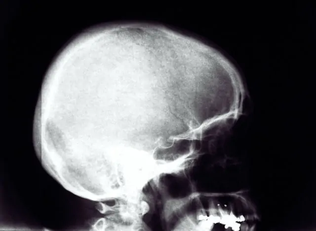 Woburn head injury claims